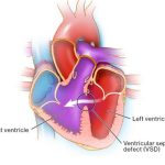 Low Cost Ventricular Septal Defect Surgery India